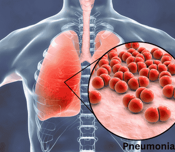 Medical illustration showing symptoms of pneumonia in the lungs